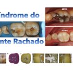síndrome do dente rachado